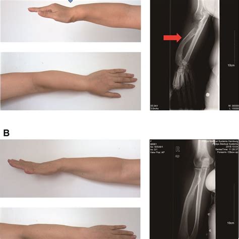 Schematic drawing of non-syndromic syndactyly types. Black digital... | Download Scientific Diagram