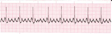 Atrial Flutter - EKG Lesson #312