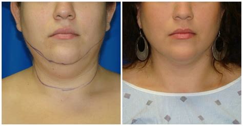 Chin Liposuction / Smartlipo in Houston TX