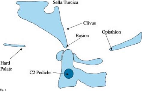 Figure 1 from Diagnosing Basilar Invagination in the Rheumatoid Patient: The Reliability of ...