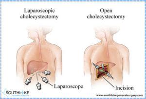 Laparoscopic Gallbladder surgery | Bile Leakage after Surgery ...