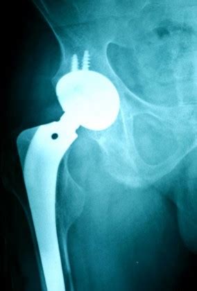 New Stryker Hip Implant Lawsuit Filed in Ark. - Top Class Actions