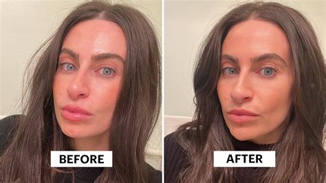 I Used Filler to Get Rid of My Cleft Chin | Allure