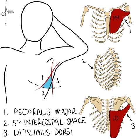 Tension Pneumothorax Needle Decompression