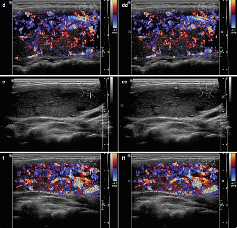 Graves’ Disease | Radiology Key