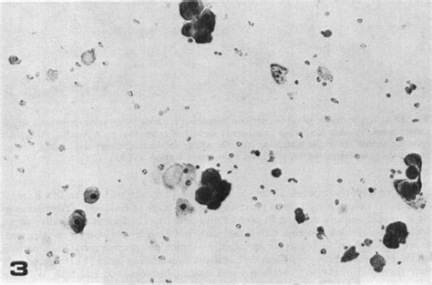 Cytocentrifuge preparation of a needle aspirate from cystic disease of... | Download Scientific ...