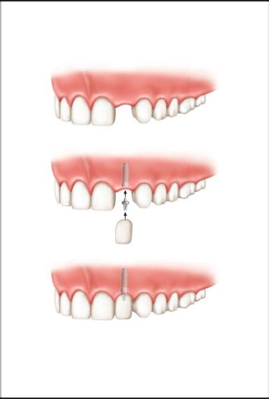 Single Tooth Implant | Chino Dental Implant