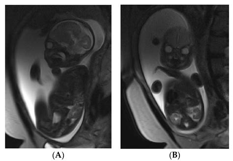 Medicina | Free Full-Text | Use of Magnetic Resonance Imaging in Evaluating Fetal Brain and ...