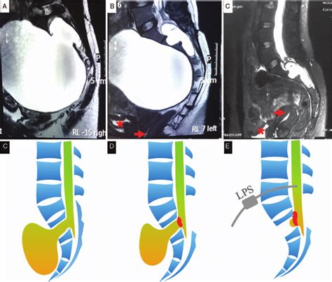 Anterior sacral meningocele in patient 1. Preoperative sagittal... | Download Scientific Diagram