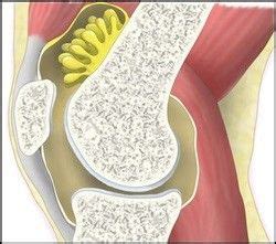 PVNS: Pigmented villonodular synovitis | Joint Replacement Patient Forum