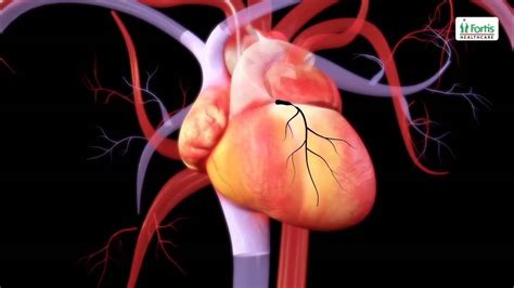 How to operate Heart, Angioplasty Procedure - YouTube