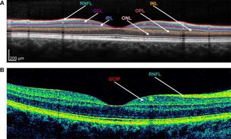 Intra-retinal layer segmentation of OCT B-scans.(A) Exe | Open-i