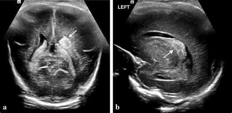 A posterior germinal matrix hemorrhage in a 25-week gestational age... | Download Scientific Diagram