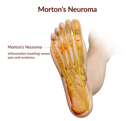 What is Morton's Neuroma — South West Foot Surgery