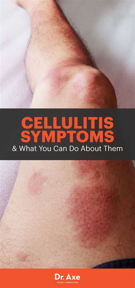 This Skin Condition Could Actually Be Lyme Disease | Plaque psoriasis treatment, Cellulitis ...