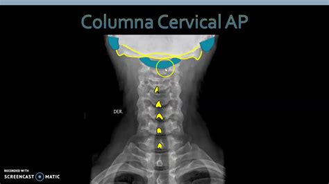 Anatomía Radiológica Columna Cervical - YouTube