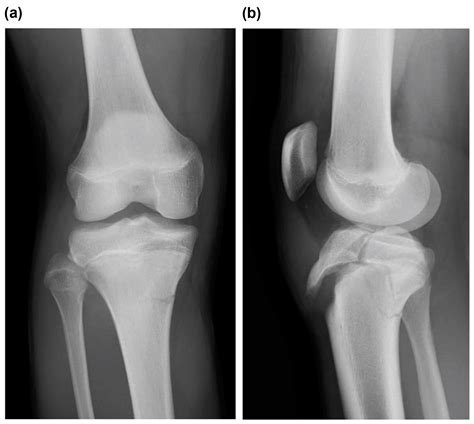 Tibial Tubercle Fracture