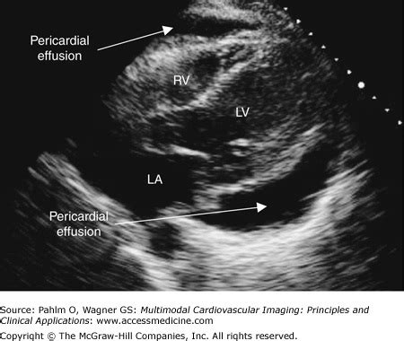 Pericardial Effusion on Transthoracic Echocardiogram | AccessMedicine ...