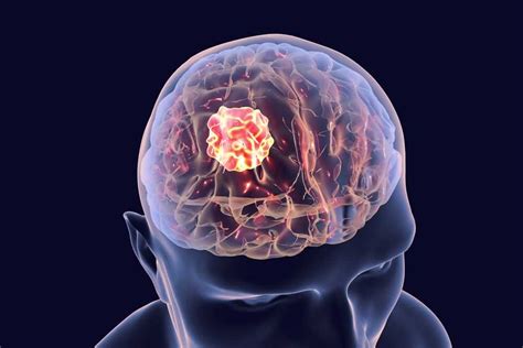 14 Warning Signs and Symptoms of Brain Tumor