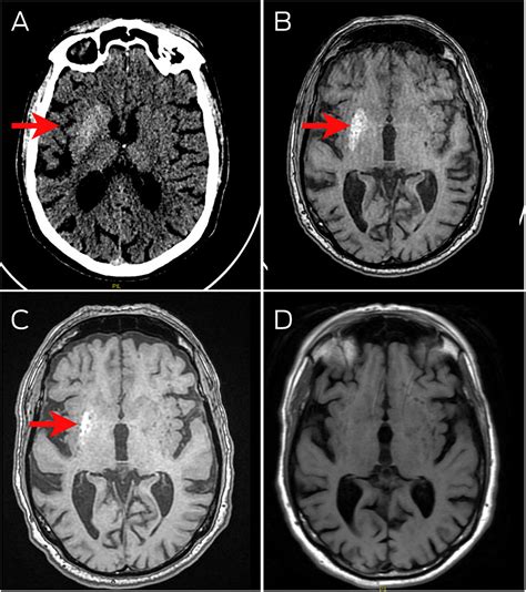 Hemichorea–hemiballismus due to hyperglycaemia | The Medical Journal of Australia