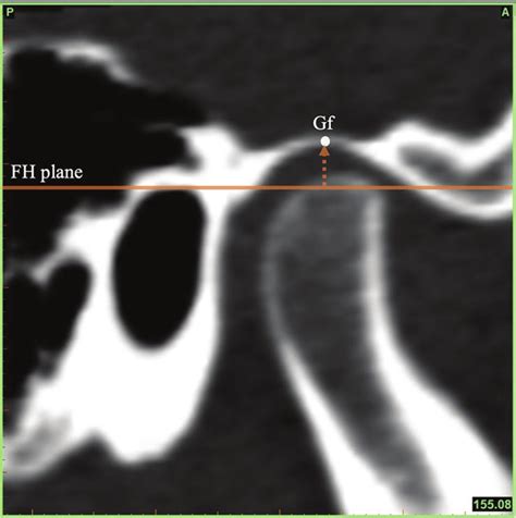 Determining the position of the glenoid fossa. The position of the... | Download Scientific Diagram