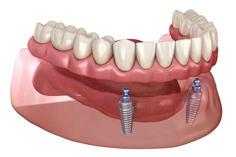 Implant-Supported Overdentures - D.R. Dental Clinics