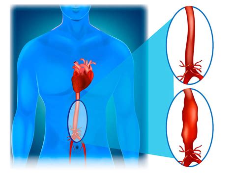 Pulmonary Embolism Aortic Aneurysm Disease Symptoms Treatment | Hot Sex Picture