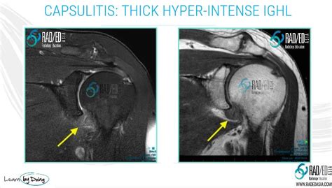 Glenohumeral Ligament Mri