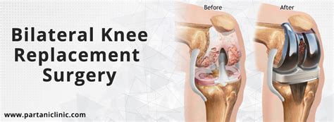 Knee Replacement Surgery in Jaipur - Dr. Arun Partani | Partani Clinic