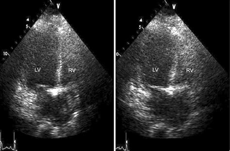 Echocardiography showed a severe LV systolic dysfunction with apical ...