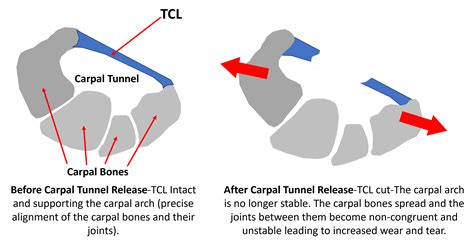 Carpal Tunnel Release and Wrist Instability - Regenexx