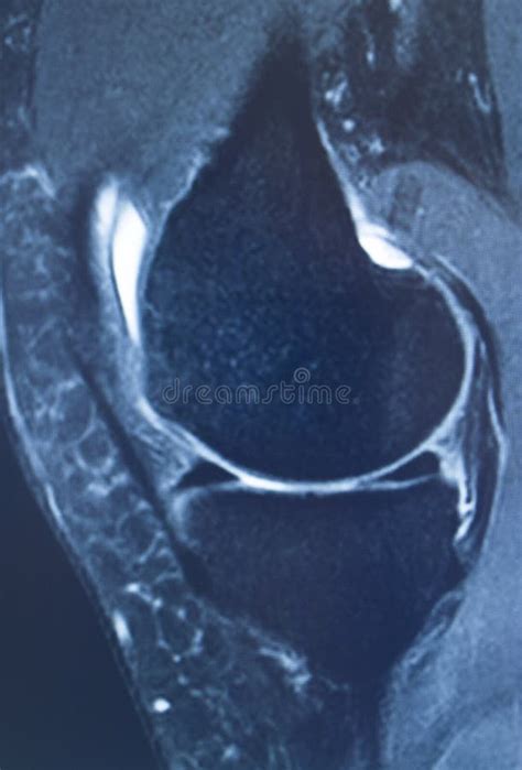 Knee injury mri mcl tear stock photo. Image of bone - 166310244