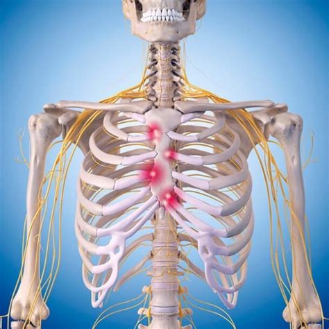 Costochondritis - MyPhysio Evolution