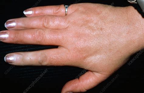 Hand of a Raynaud's syndrome sufferer - Stock Image - M250/0014 - Science Photo Library