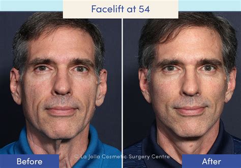 Facelift Before & After Photos: What a Facelift Looks Like at 40, 50, 60 & 70 | Facelift in San ...