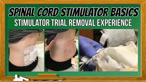 Spinal Cord Stimulator Trial Removal (Includes SCS & DRG Trial Removal Footage) - YouTube