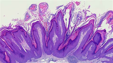 Verruca Plana Histopathology