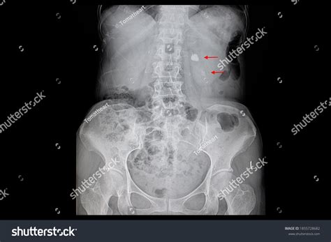 X Ray Or Ct Scan For Kidney Stone