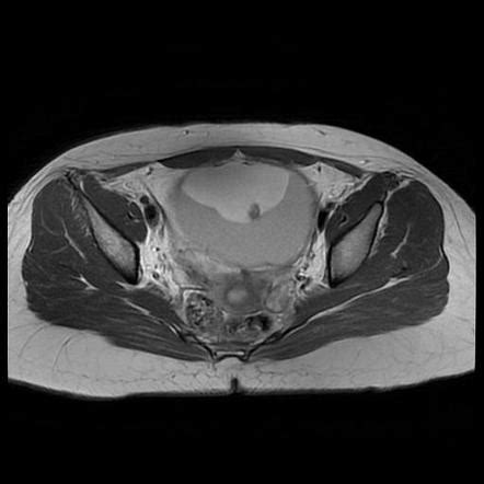 Ovarian dermoid cyst - MRI | Radiology Case | Radiopaedia.org