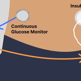 Artificial Pancreas System | Download Scientific Diagram