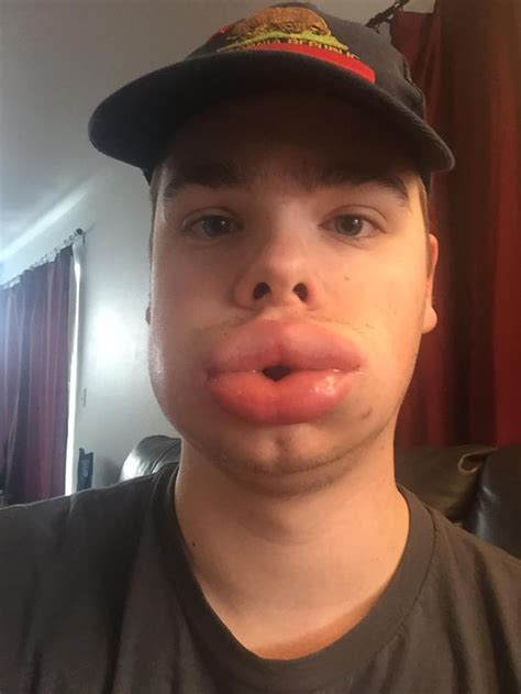 PsBattle: Severe allergic reaction, Lip and cheek swelling : r ...