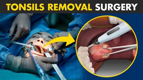 How Tonsillectomy Procedure Is Performed? | Tonsils Removal Surgery (Tonsillectomy) - YouTube