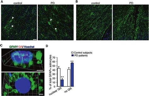 GFAP astrocytes analyzed for GR expression in SN postmortem from ...