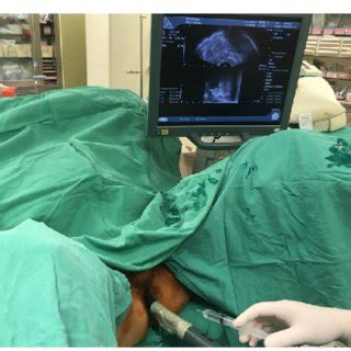 Transperineal prostate biopsy mapping. Systemic biopsy includes 6 cores ...