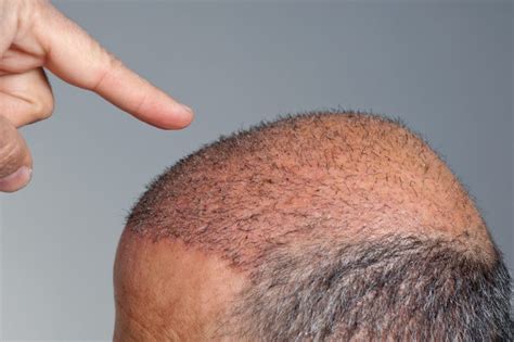 Everything about Hair Transplant Scars - Richmond Hill Cosmetic Clinic