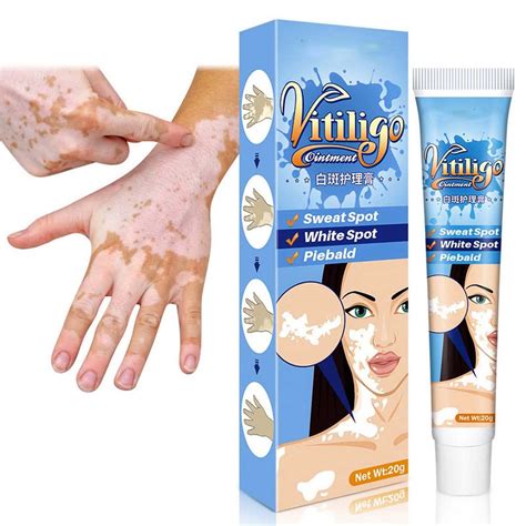 Buy Vitiligo Cream, Vitiligo , Vitiligo Care Cream, Vitiligo Cream for ...