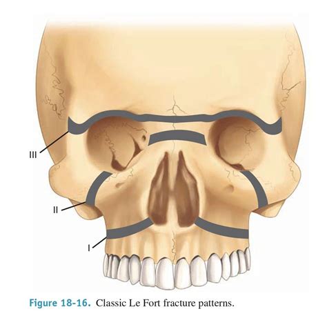 Le fort 1 ( transverse #) ...2 ( pyraamida in shape .. Orbital floor always involved) 3 ...