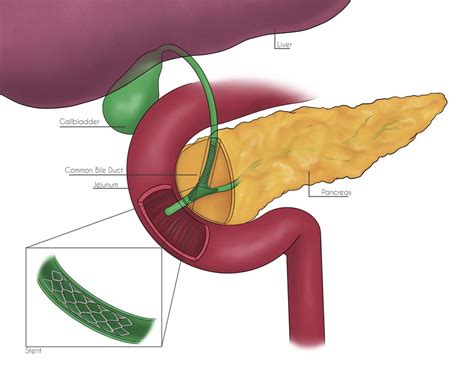 Common Bile Duct Stent Illustration by Anna Clunis | Medical ...