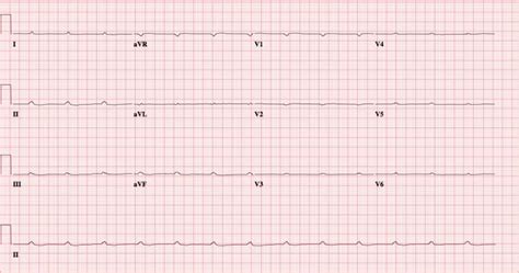 Complete Ventricular Asystole in a Patient with Altered Mental Status ...