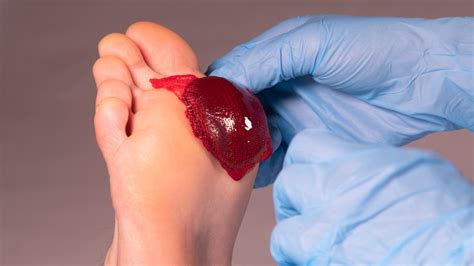 A revolutionary blood clot that can heal chronic wounds - ISRAEL21c